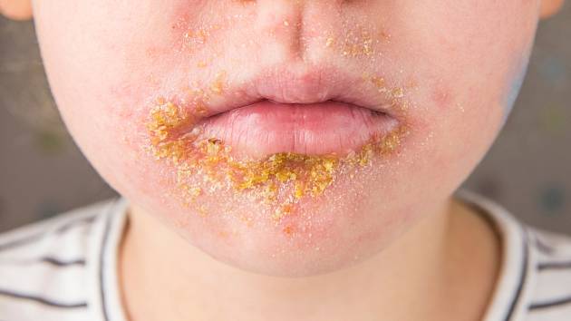 8-impetigo_denik-630-16x9.jpg